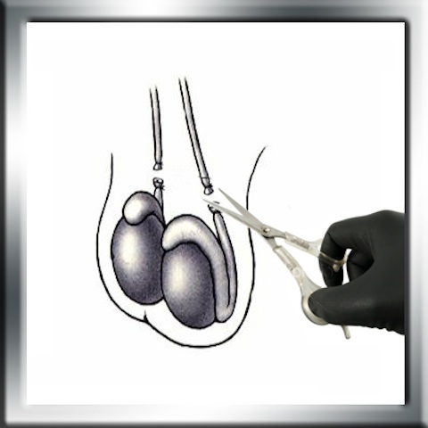 vasectomy 2